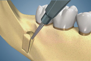 Autograft-Buccal Shelf Using Trephine